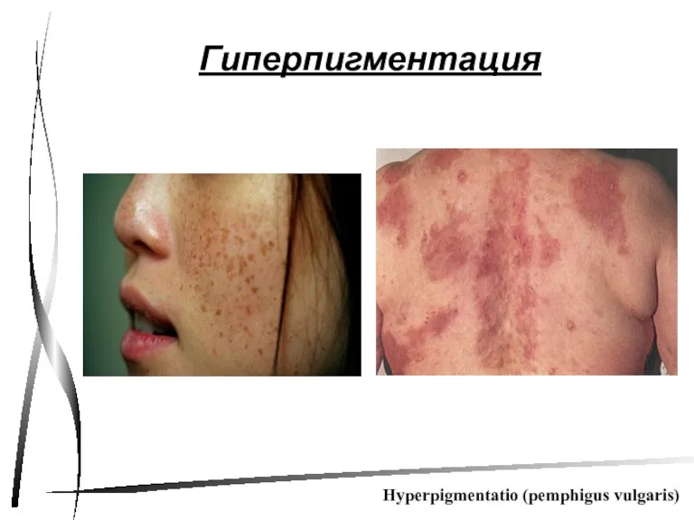 Гиперпигментация Hyperpigmentatio (pemphigus vulgaris)