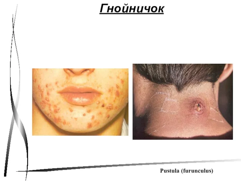 Гнойничок Pustula (furunculus)