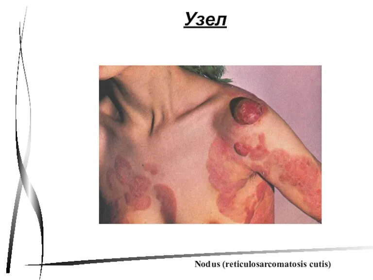 Узел Nodus (reticulosarcomatosis cutis)