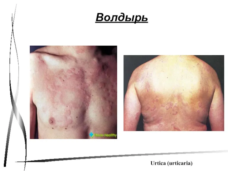 Волдырь Urtica (urticaria)