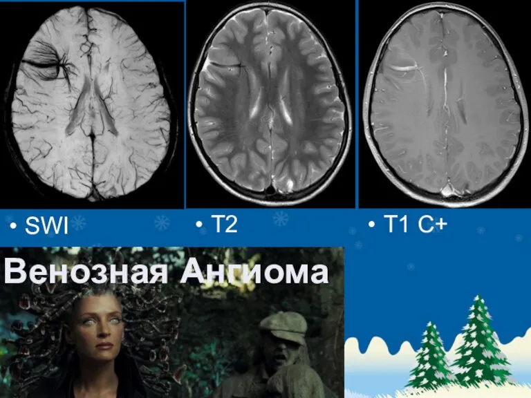 SWI T2 T1 C+ Венозная Ангиома