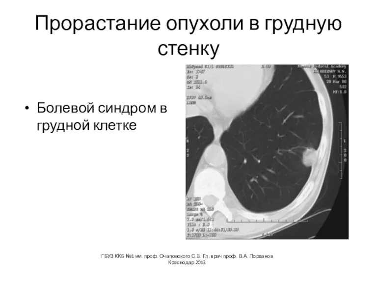 Прорастание опухоли в грудную стенку Болевой синдром в грудной клетке ГБУЗ ККБ