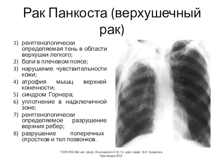 Рак Панкоста (верхушечный рак) 1) рентгенологически определяемая тень в области верхушки легкого;