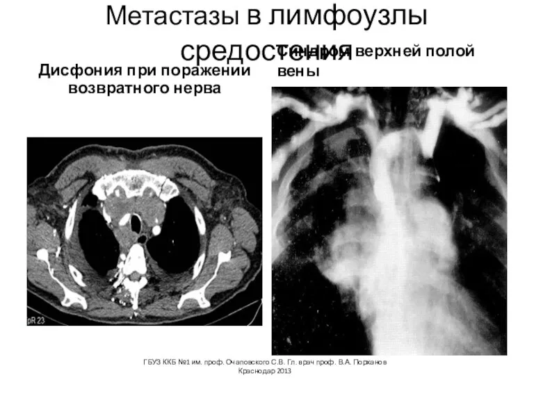 Метастазы в лимфоузлы средостения Дисфония при поражении возвратного нерва Синдром верхней полой