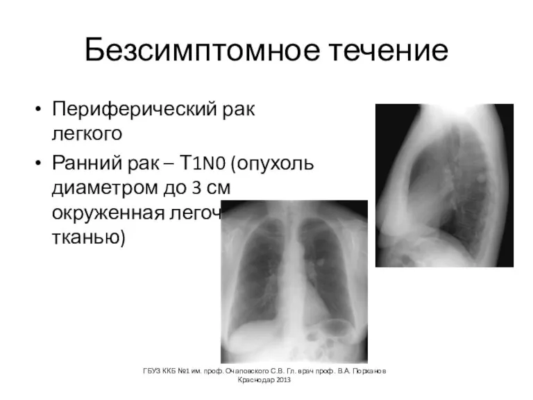 Безсимптомное течение Периферический рак легкого Ранний рак – Т1N0 (опухоль диаметром до