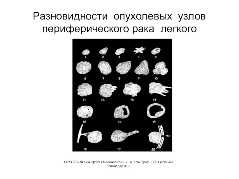 Разновидности опухолевых узлов периферического рака легкого ГБУЗ ККБ №1 им. проф. Очаповского