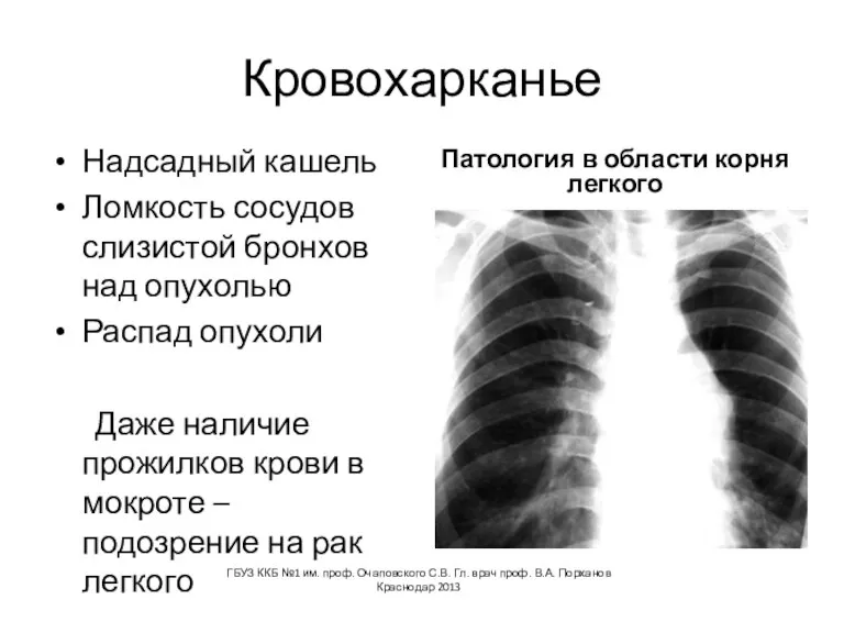 Кровохарканье Надсадный кашель Ломкость сосудов слизистой бронхов над опухолью Распад опухоли Даже