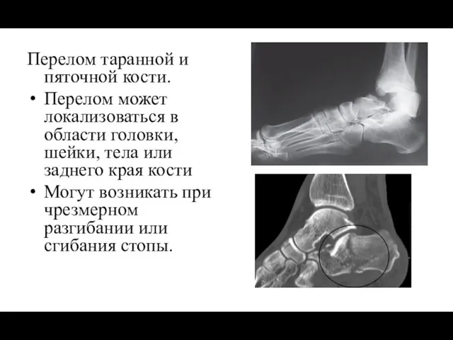 Перелом таранной и пяточной кости. Перелом может локализоваться в области головки, шейки,