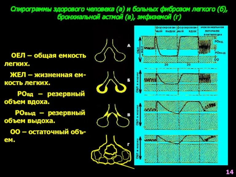 Спирограммы здорового человека (а) и больных фиброзом легкого (б), бронхиальной астмой (в),