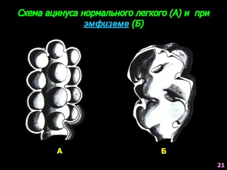 Схема ацинуса нормального легкого (А) и при эмфиземе (Б) А Б 21