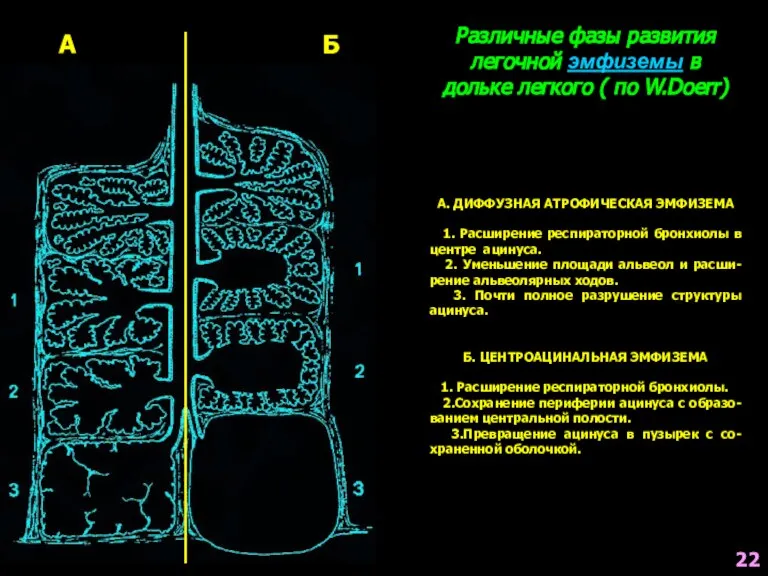 Различные фазы развития легочной эмфиземы в дольке легкого ( по W.Doerr) А