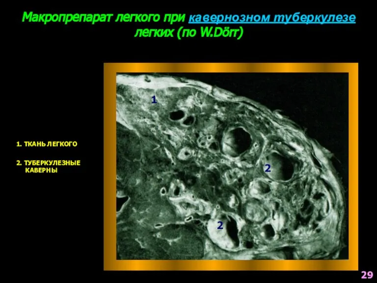 Макропрепарат легкого при кавернозном туберкулезе легких (по W.Dörr) 1. ТКАНЬ ЛЕГКОГО 1