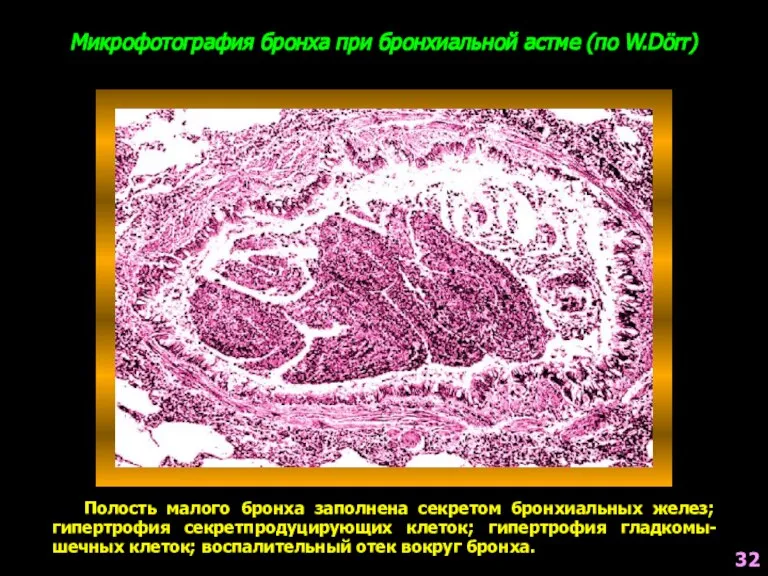 Микрофотография бронха при бронхиальной астме (по W.Dörr) Полость малого бронха заполнена секретом