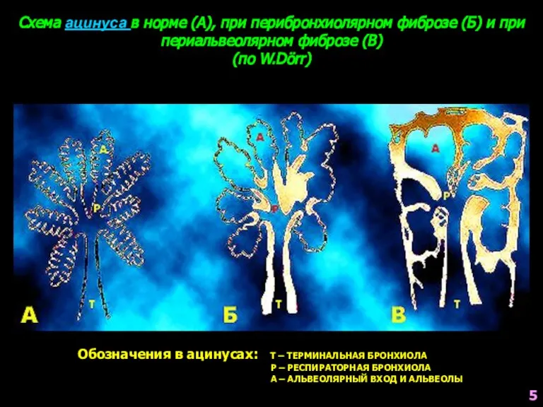 Схема ацинуса в норме (А), при перибронхиолярном фиброзе (Б) и при периальвеолярном