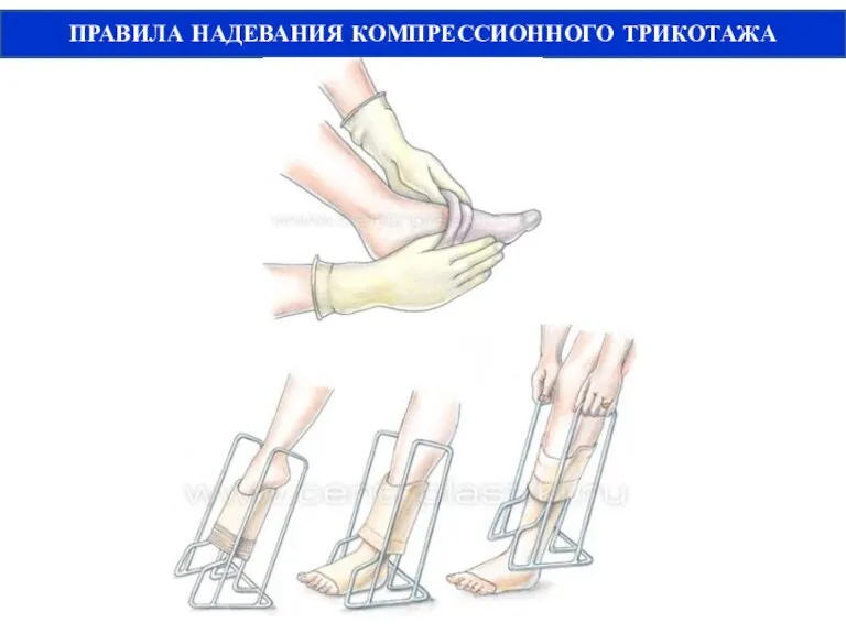 ПРАВИЛА НАДЕВАНИЯ КОМПРЕССИОННОГО ТРИКОТАЖА