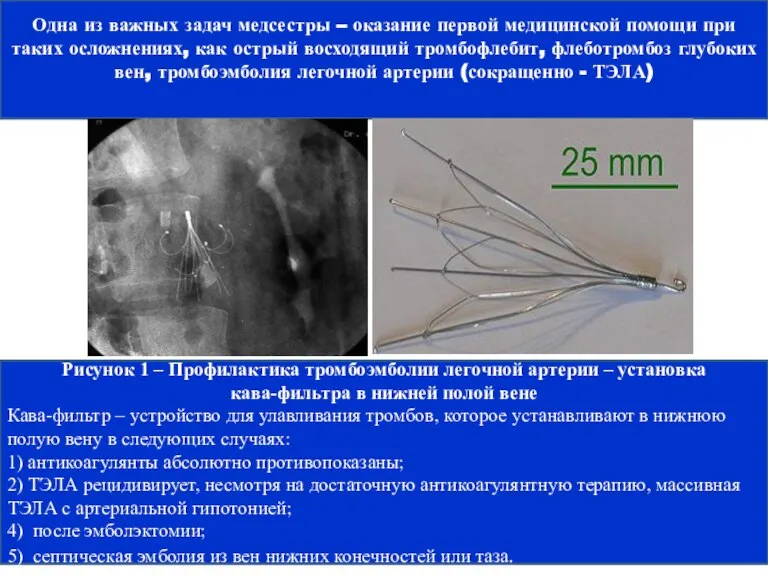 Рисунок 1 – Профилактика тромбоэмболии легочной артерии – установка кава-фильтра в нижней