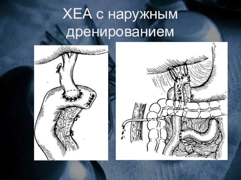 ХЕА с наружным дренированием