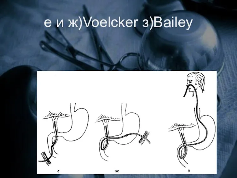 е и ж)Voelcker з)Bailey