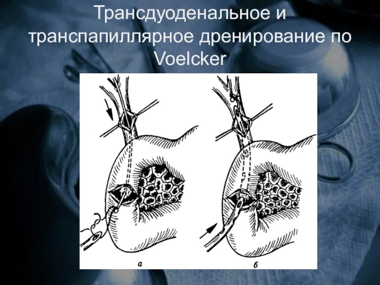 Трансдуоденальное и транспапиллярное дренирование по Voelcker