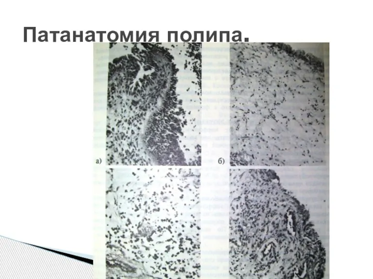 Патанатомия полипа.