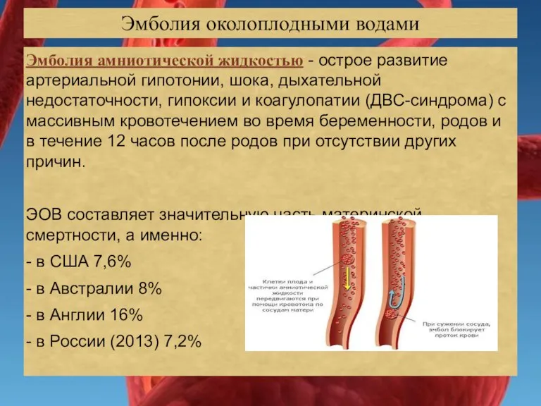 Эмболия амниотической жидкостью - острое развитие артериальной гипотонии, шока, дыхательной недостаточности, гипоксии