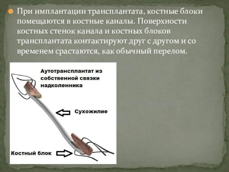 При имплантации трансплантата, костные блоки помещаются в костные каналы. Поверхности костных стенок