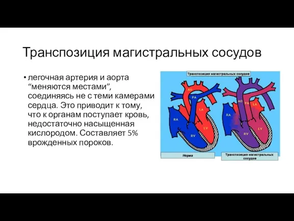 Транспозиция магистральных сосудов легочная артерия и аорта “меняются местами”, соединяясь не с