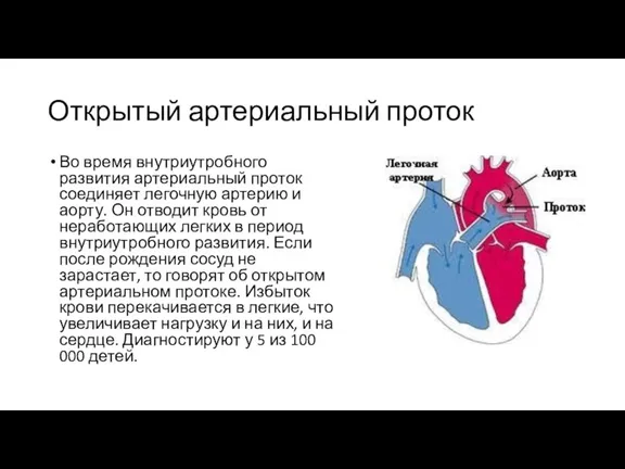Открытый артериальный проток Во время внутриутробного развития артериальный проток соединяет легочную артерию