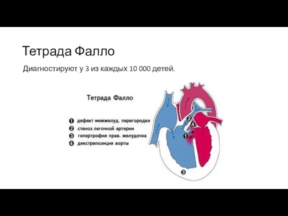 Тетрада Фалло Диагностируют у 3 из каждых 10 000 детей.