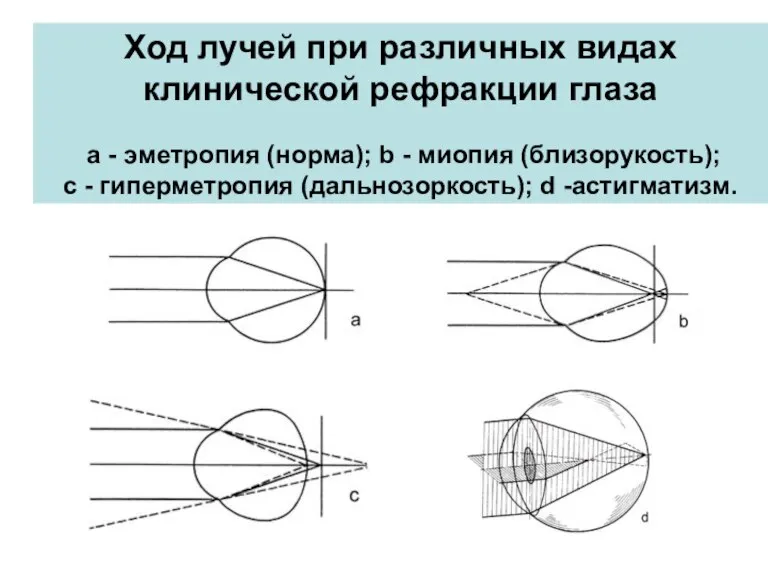 Ход лучей при различных видах клинической рефракции глаза a - эметропия (норма);