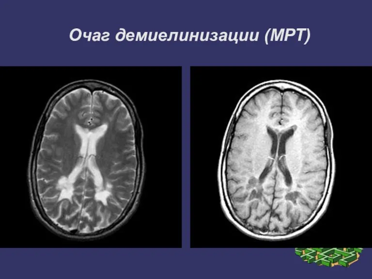 Очаг демиелинизации (МРТ)