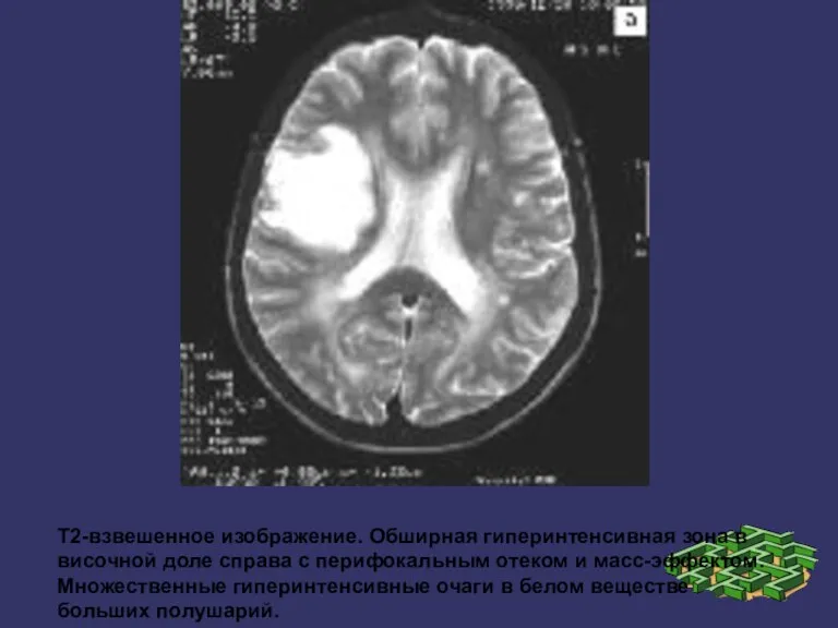 Т2-взвешенное изображение. Обширная гиперинтенсивная зона в височной доле справа с перифокальным отеком