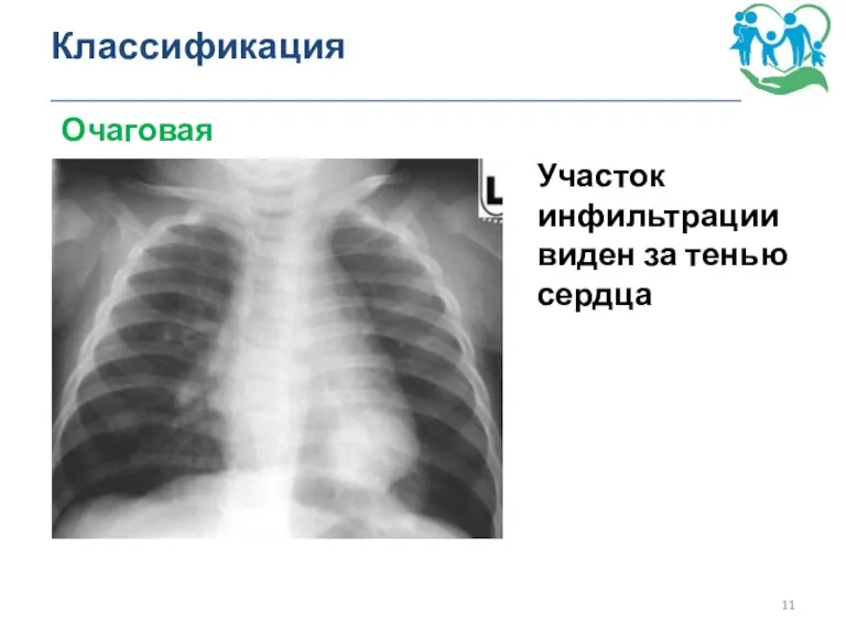 Классификация _______________________________________________ Очаговая пневмония Участок инфильтрации виден за тенью сердца