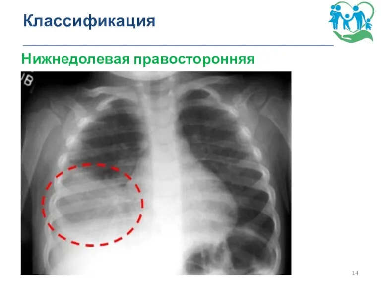 Классификация _______________________________________________ Нижнедолевая правосторонняя пневмония