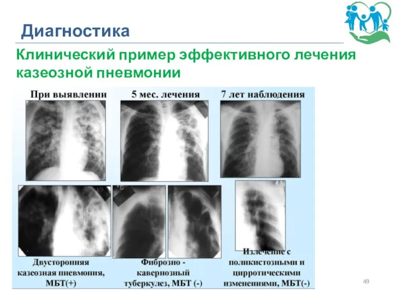 Диагностика Клинический пример эффективного лечения казеозной пневмонии