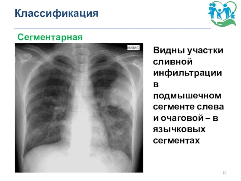 Классификация _______________________________________________ Сегментарная пневмония Видны участки сливной инфильтрации в подмышечном сегменте слева