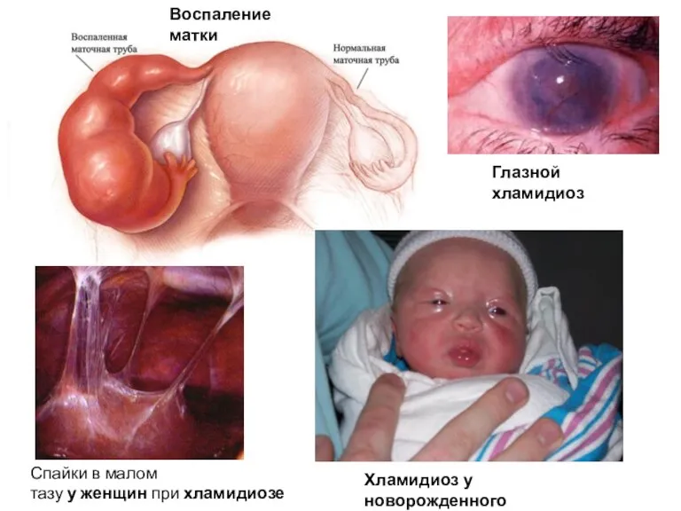 Воспаление матки Спайки в малом тазу у женщин при хламидиозе Хламидиоз у новорожденного Глазной хламидиоз