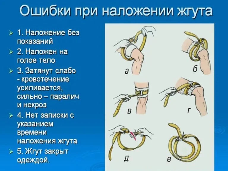 Ошибки при наложении жгута