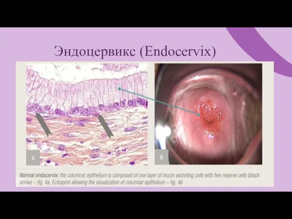 Эндоцервикс (Endocervix)