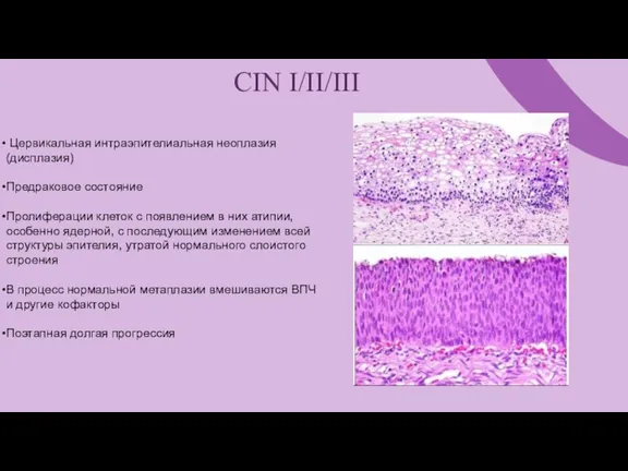 CIN I/II/III Цервикальная интраэпителиальная неоплазия (дисплазия) Предраковое состояние Пролиферации клеток с появлением