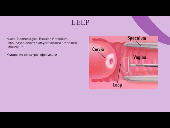 LEEP Loop Electrosurgical Excision Procedure – процедура электрохирургического петлевого иссечения Удаление зоны трансформации