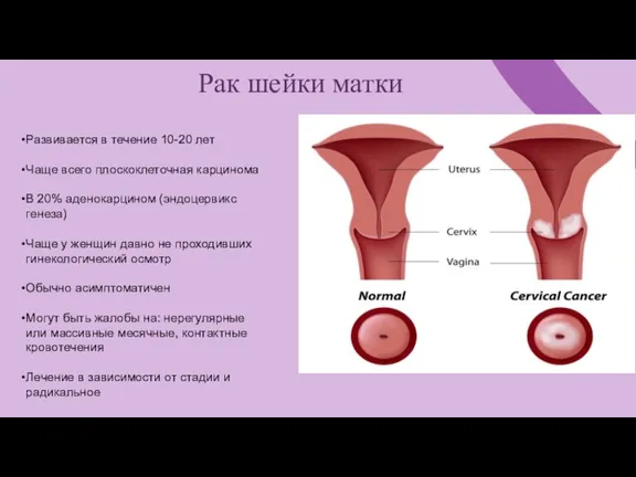 Рак шейки матки Развивается в течение 10-20 лет Чаще всего плоскоклеточная карцинома