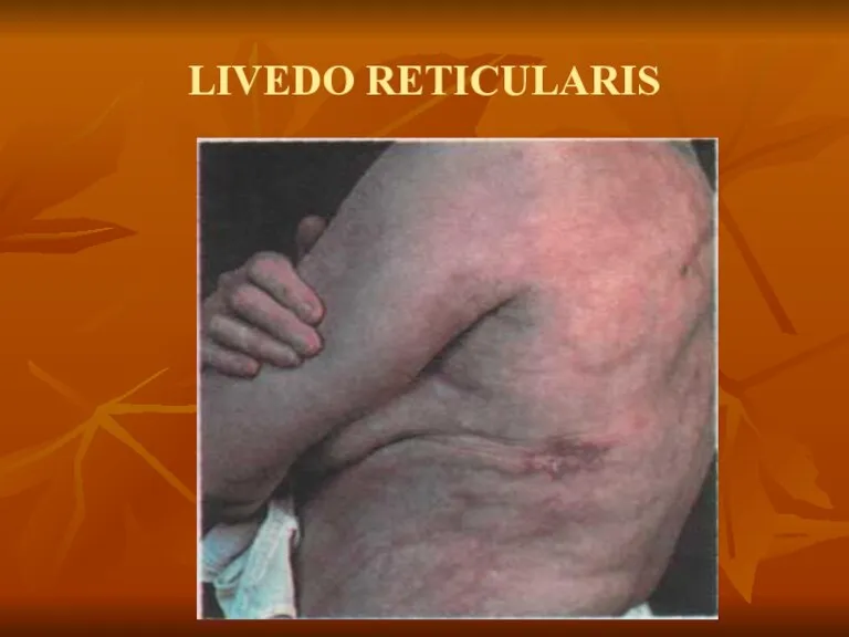 LIVEDO RETICULARIS