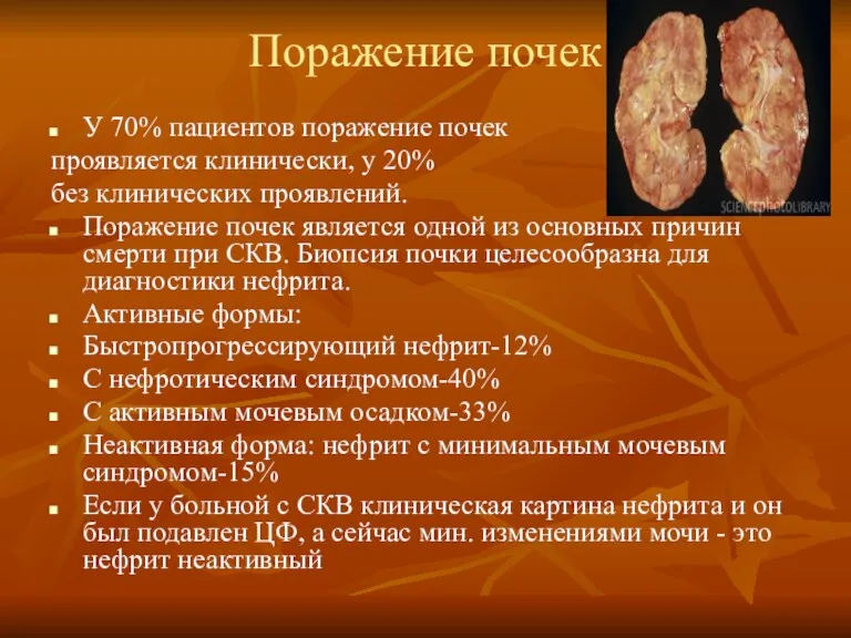 Поражение почек У 70% пациентов поражение почек проявляется клинически, у 20% без