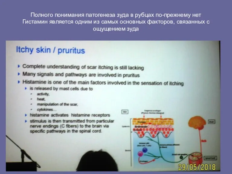 Полного понимания патогенеза зуда в рубцах по-прежнему нет Гистамин является одним из