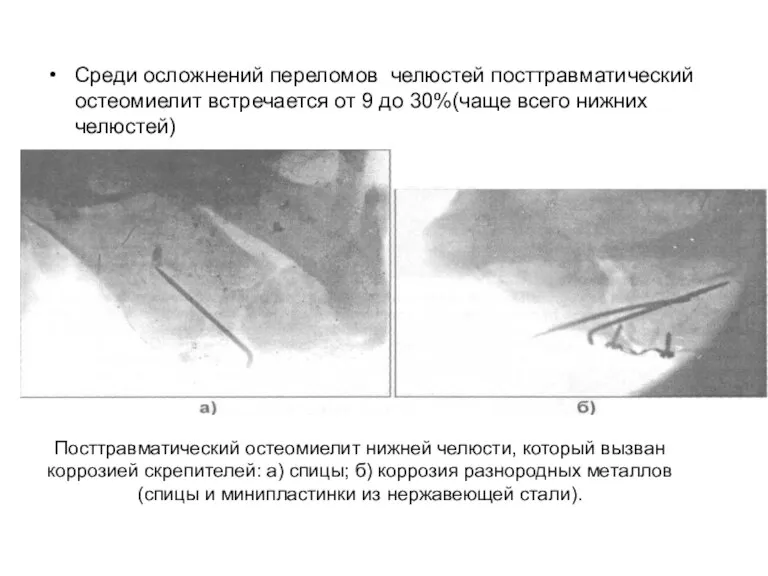 Среди осложнений переломов челюстей посттравматический остеомиелит встре­чается от 9 до 30%(чаще всего