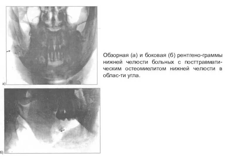 Обзорная (а) и боковая (б) рентгено-граммы нижней челюсти больных с посттравмати-ческим остеомиелитом