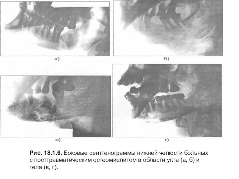 Рис. 18.1.6. Боковые рентгенограммы нижней челюсти больных с посттравматическим остеомиелитом в области