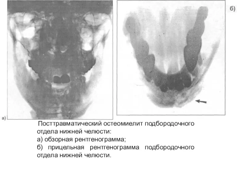 Посттравматический остеомиелит подбородочного отдела нижней челюсти: а) обзорная рентгенограмма; б) прицельная рентгенограмма подбородочного отдела нижней челюсти.