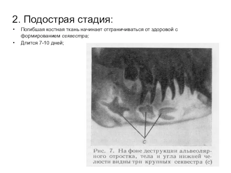 2. Подострая стадия: Погибшая костная ткань начинает отграничиваться от здоровой с формированием секвестра; Длится 7-10 дней;
